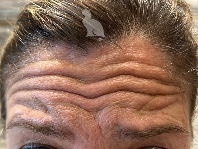 antes botox