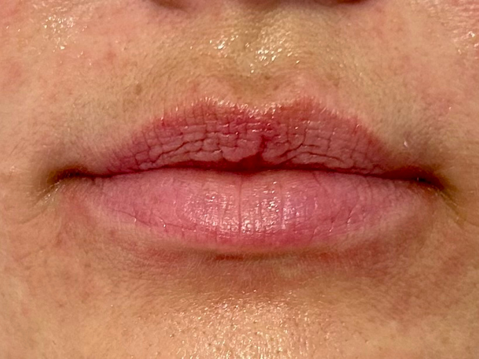 antes labios