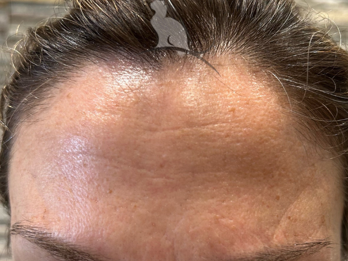 después botox